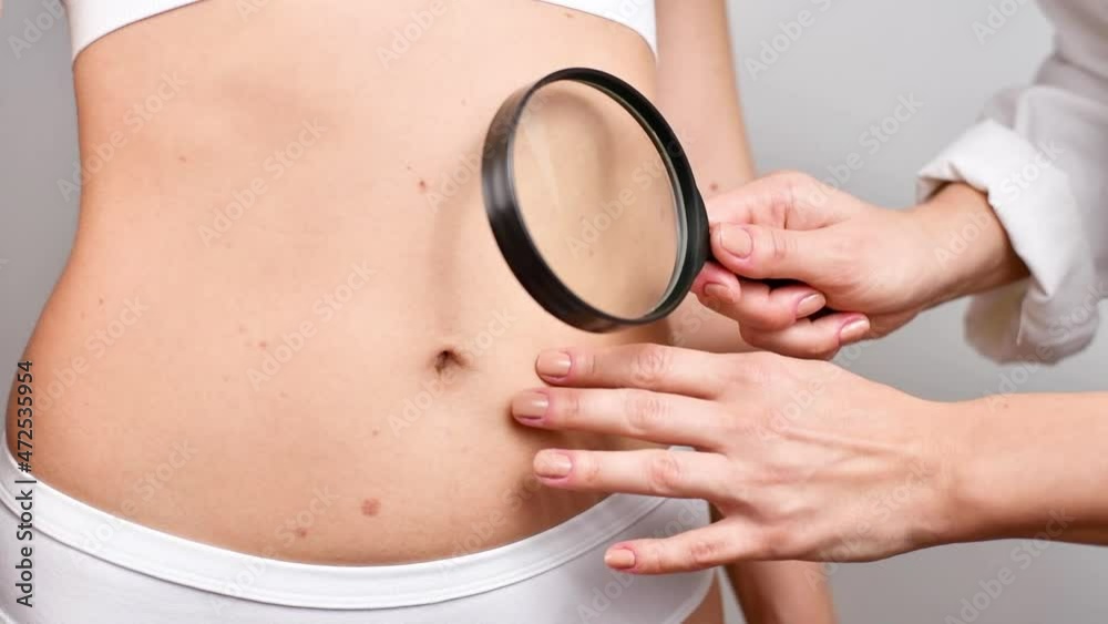 Doctor dermatologist examines birthmark of patient.