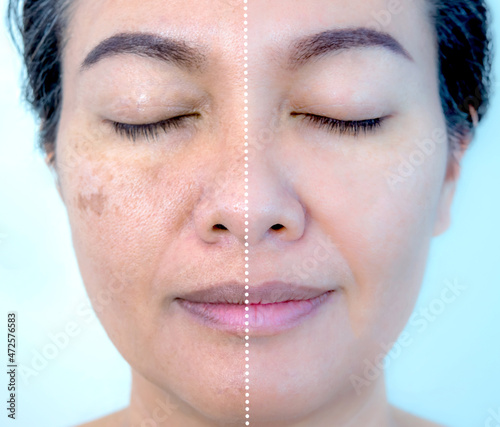 Retouched image before and after spot melasma pigmentation facial treatment on middle age asian woman face. Skincare and health problem concept. 