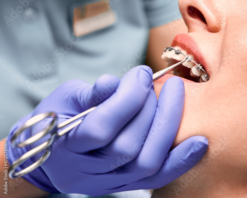 Close up of dentist hand putting elastic rubber band on patient brackets. Woman with wired metal braces on teeth receiving orthodontic treatment. Concept of stomatology, dentistry and orthodontics. photo