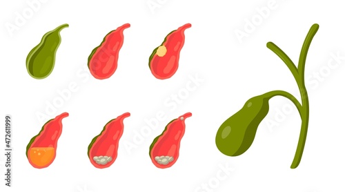 Gall bladder diseases in cartoon style, vector