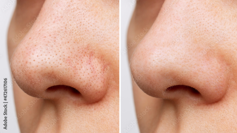 Close-up of woman's nose with blackheads or black dots before and after peeling and cleansing the face isolated on a white background. Acne problem, comedones. Cosmetology dermatology concept - obrazy, fototapety, plakaty 