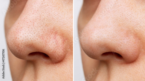 Close-up of woman's nose with blackheads or black dots before and after peeling and cleansing the face isolated on a white background. Acne problem, comedones. Cosmetology dermatology concept photo