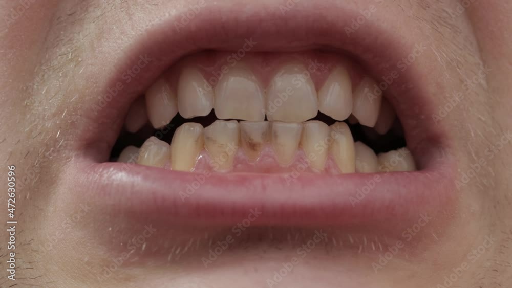 Rotten human teeth, close-up. Dental calculus in dentistry, black tooth, problema