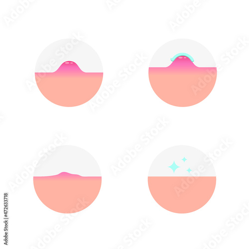 Treating inflammation. An abscess, a lump on the skin. Stages of elimination of inflammation after application of an anti-inflammatory agent. Vector illustration, flat minimal cartoon color design.