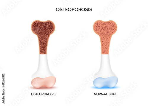 Healthy bone and unhealthy bone, Osteoporosis. Medical or healthcare concept. bone protection. Isolated on a white background. Realistic 3d Vector illustration 