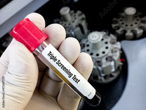 Scientist holding blood sample for Triple screening test(AFP, beta HCG and uE3). It can help our baby may be at higher risk for certain birth defects photo