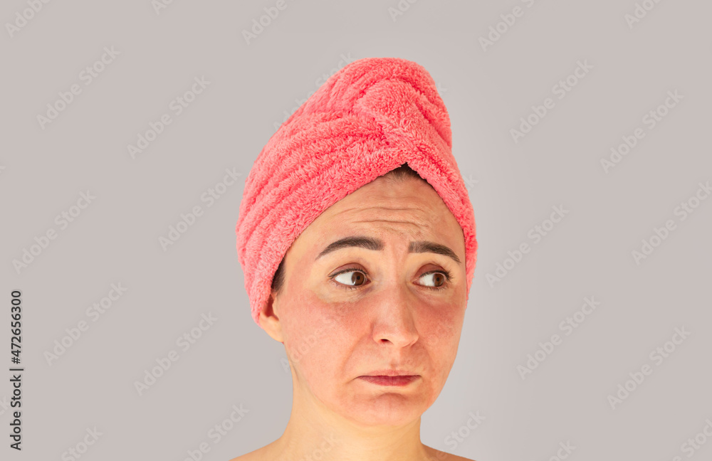 Face with skin irritation, problems, acne, rash or sunburn Face with skin irritation, problems, acne, rash or sunburn