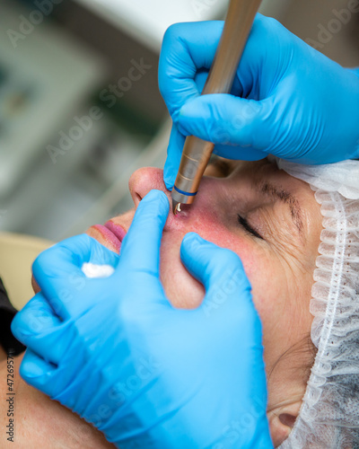 Removal of red spots, rosacea, blood vessels, on the face of a Caucasian woman. Laser apparatus. 