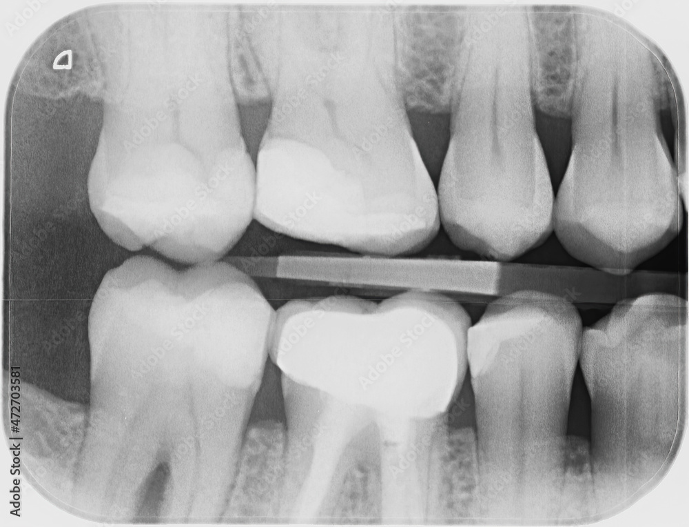 Xray of four upper and four lower human teeth. Some of the teeth have