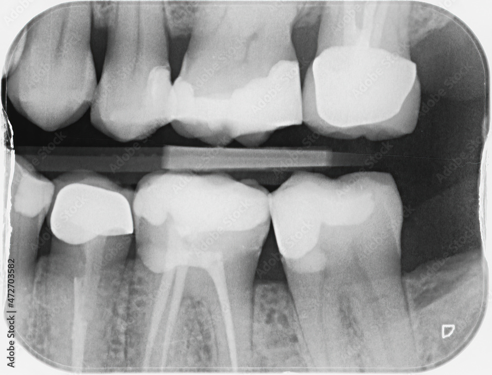 Fotka „Xray of four upper and four lower human teeth. Some of the