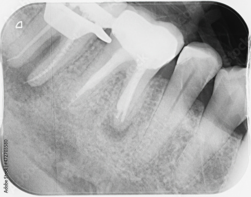 X-ray of four human teeth, two molars have been heavily filled and had root canal treatments following an infection, abscess. Infections visible at end of roots showing further treatment required.