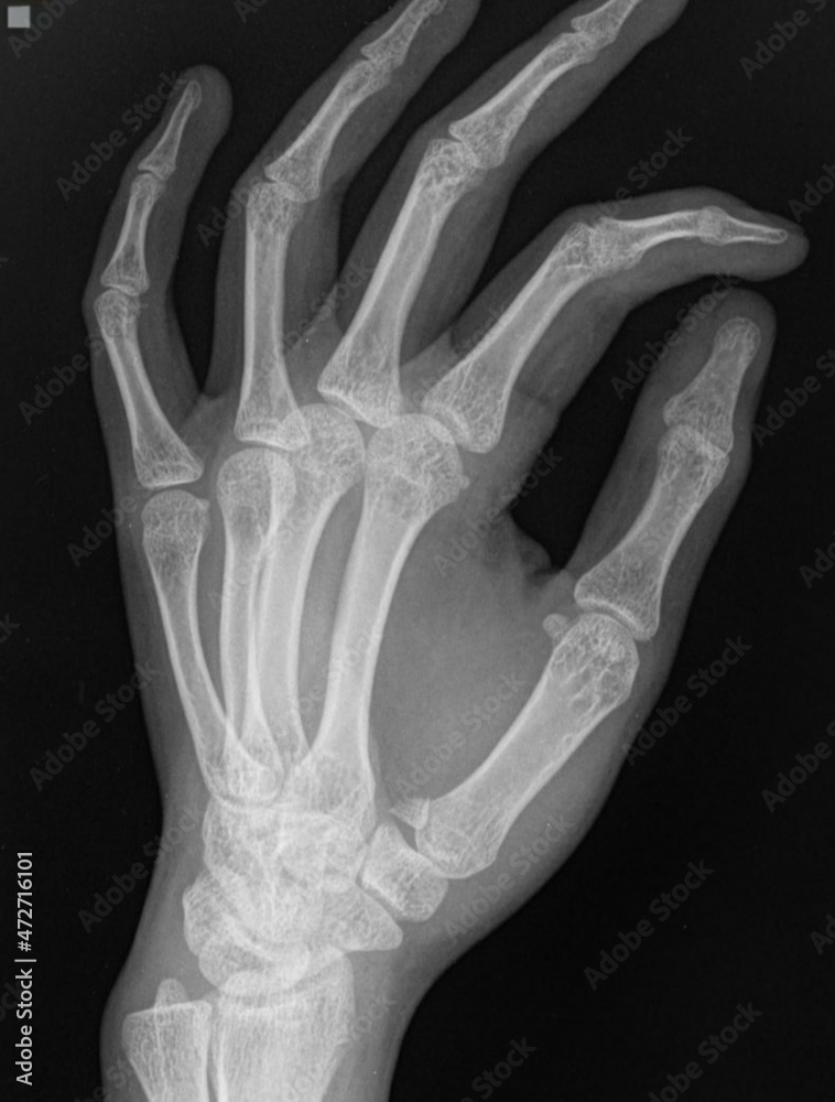 x ray of human hand,base thumb fracture Stock Photo