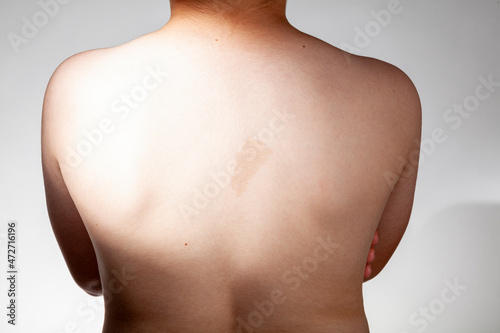 A large light brown cafe au lait spot known as birth mark on the inter scapular region of a caucasian male. This benign skin discoloration may be related to a genetical disorder neurofibromatosis. photo