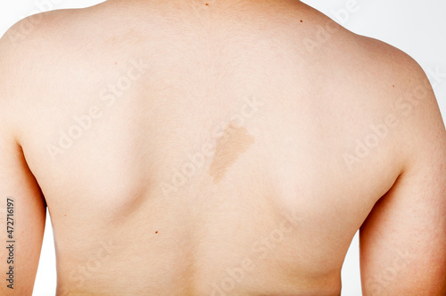 A large light brown cafe au lait spot known as birth mark on the inter scapular region of a caucasian male. This benign skin discoloration may be related to a genetical disorder neurofibromatosis.