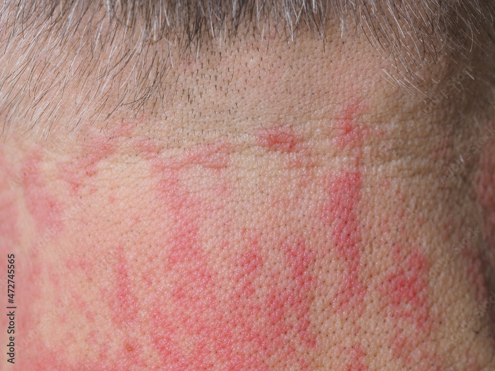 Fototapeta premium red spots allergy irritation on a man's neck
