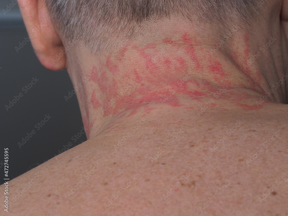 red spots allergy irritation on a man's neck red spots allergy irritation on a man's neck