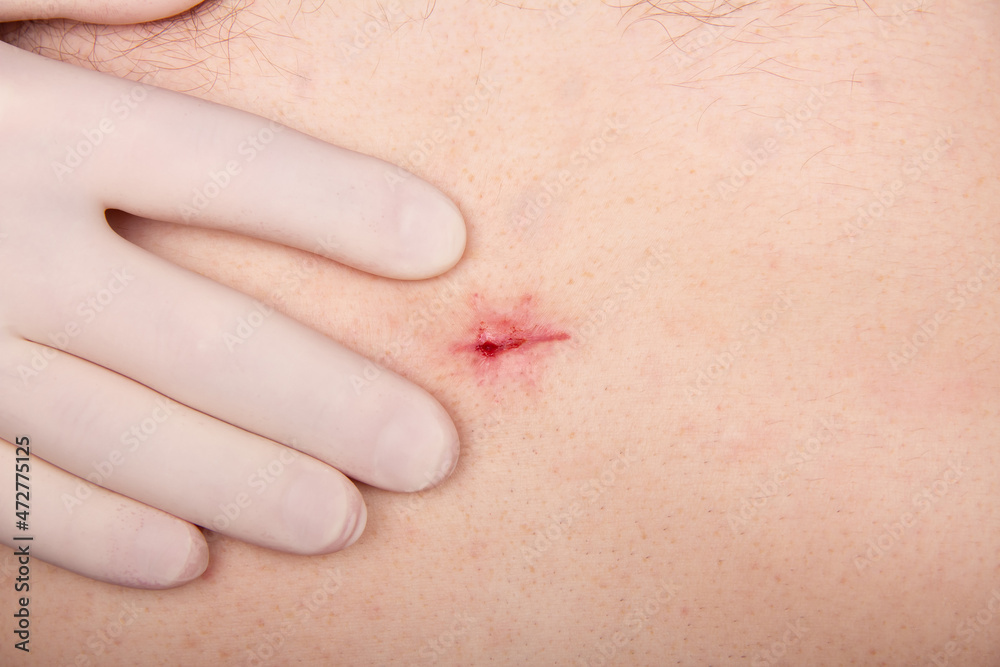 Suture on the patient's body after a successful cholecystectomy is checked by the surgeon Suture on the patient's body after a successful cholecystectomy is checked by the surgeon