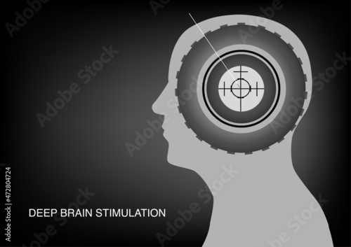 Deep brain stimulation surgery for Parkinson's disease. Placement of lead electrode at the target with intraoperative fluoroscopy.