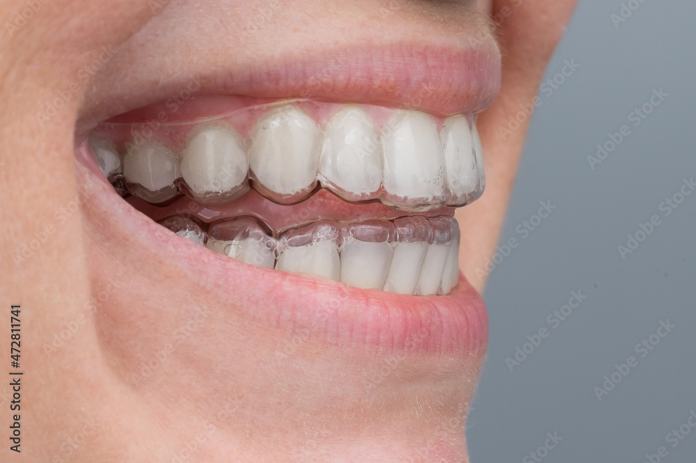 Fototapeta premium Close-up of a caucasian woman smiling with aligners on her teeth. Macro.