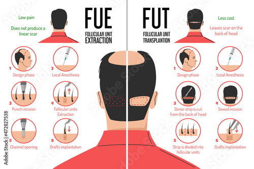FUT and FUE hair transplantation process vector isolated. Follicular unit extraction or transplantation. Baldness problem, surgical treatment. Graft implantation, medical infographic.