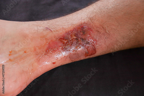 A third-degree burn on the leg of a Caucasian male against black background