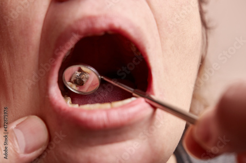 Examination of the condition of teeth and their damage with the help of a dental mirror. Dentistry. © Vasyl