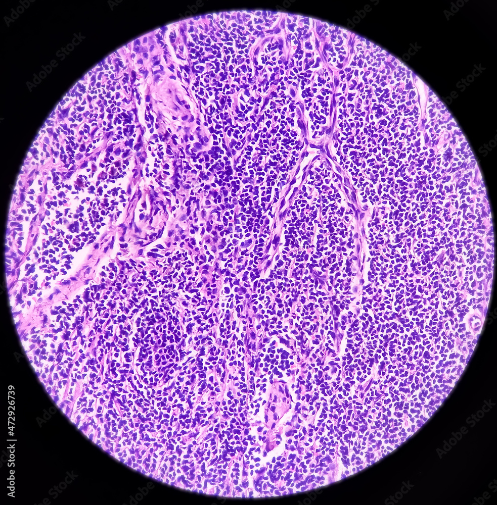 Lymph Angioma Photomicrograph Of Lymphangiomacystic Hygroma Or Lymphatic Malformation Benign 