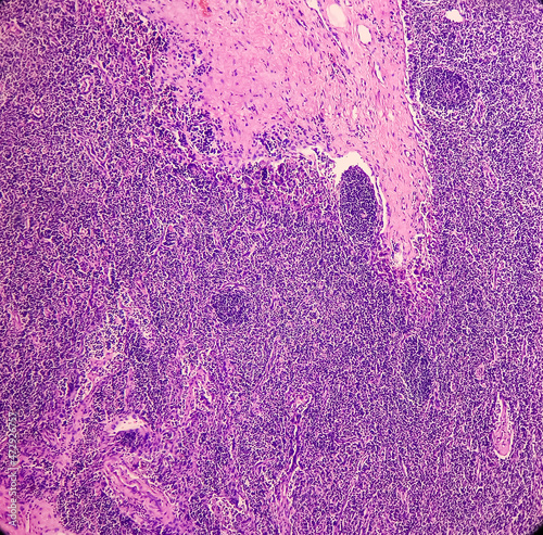 Obraz na plátně Lymph angioma, Photomicrograph of lymphangioma(cystic hygroma) or lymphatic malformation, benign lesions,  noncancerous, fluid-filled cysts that occur in lymphatic vessels