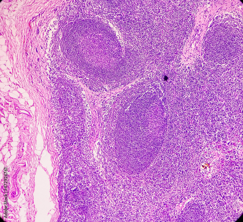 Canvas Print Lymph angioma, Photomicrograph of lymphangioma(cystic hygroma) or lymphatic malformation, benign lesions,  noncancerous, fluid-filled cysts that occur in lymphatic vessels