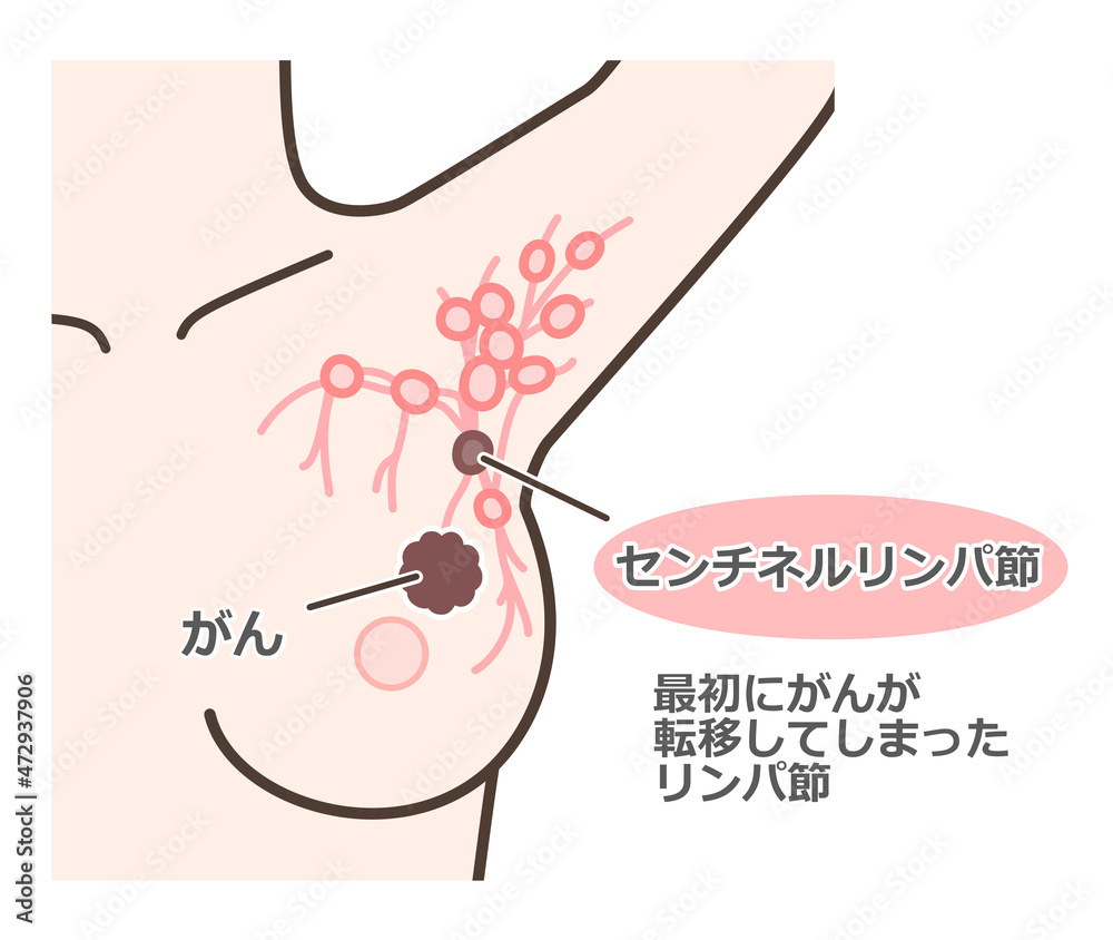 Fototapeta premium センチネルリンパ節生検の解説イラスト