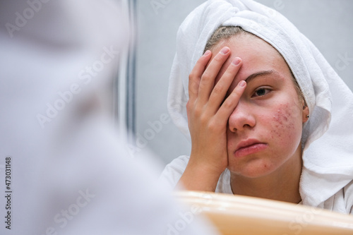 Acne. A sad teenage girl. Problematic skin in adolescents.