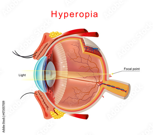 Hyperopia eyesight disorder. Hyperopia is being farsighted. Anatomy of the eye, cross section. Isolated Vector.