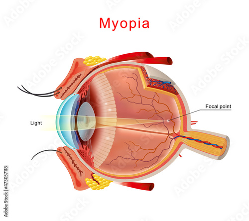 Myopia is being short sighted. Detailed anatomy of the eye. Vector