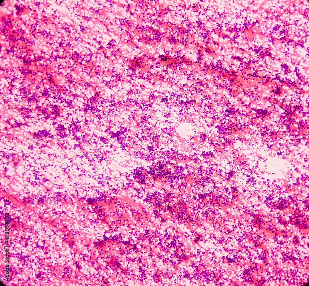 Lung cancer, photomicrograph of small cell carcinoma, malignant cells, sample sapirate from lung mass by CT guided FNA, show atypical small round cells, granular salt pepper chromatin Lung cancer, photomicrograph of small cell carcinoma, malignant cells, sample sapirate from lung mass by CT guided FNA, show atypical small round cells, granular salt pepper chromatin