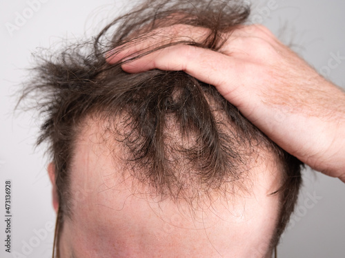 Close up of a young man holding his hair back showing clear signs of a receding hairline and hair loss. Concept showing the first stages of male pattern baldness with bald patches and thinning hair.