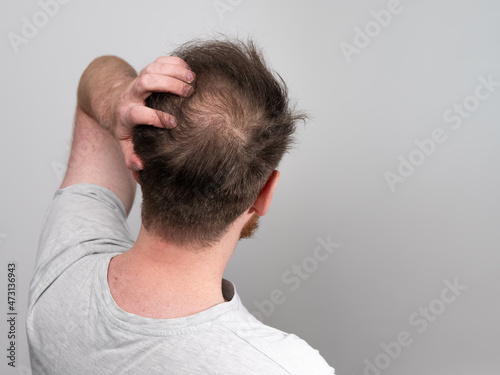 Behind view of a young balding man's head showing clear signs of balding and hair loss around the scalp. Male pattern baldness concept against a clear white background with room for text.