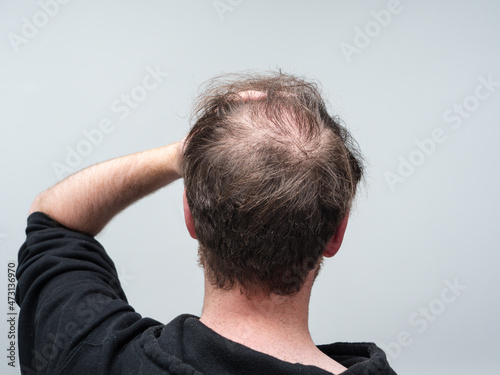 Back of a young balding man's head showing clear signs of balding and hair loss around the scalp. Male pattern baldness concept against a clear white background with room for text.