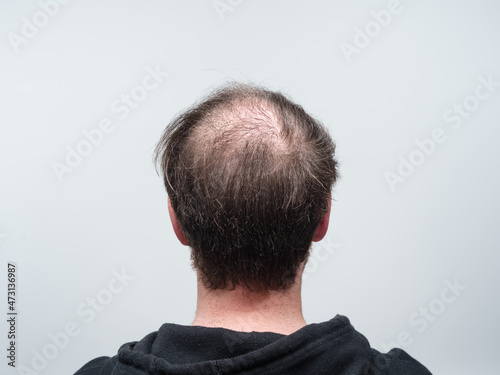 Back of a young balding man's head showing clear signs of concentrated hair loss around the scalp area. Male pattern baldness concept against a clear white background with room for text.