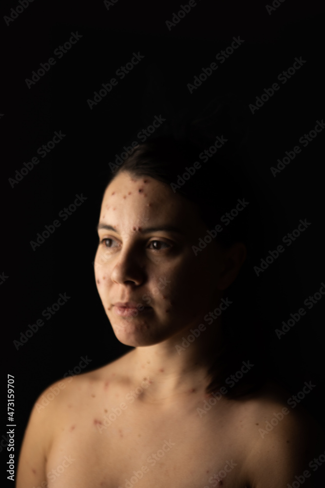 adult woman portrait chickenpox disease adult woman portrait chickenpox disease