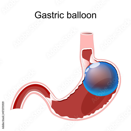 Gastric balloon. Intragastric Balloon Inside a Stomach.