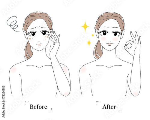 女性　美肌　肌トラブル　美容　スキンケア　シミ　老人性色素斑　肝斑　悩む顔　困り顔　ビフォーアフター