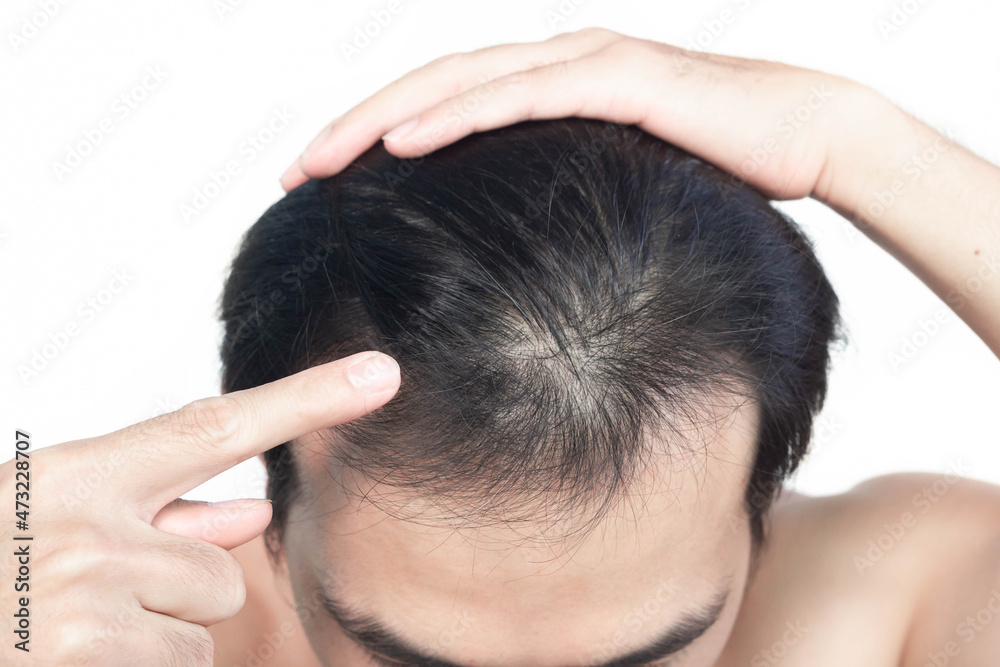 Closeup Young man serious hair loss problem with white backgroun for health care medical and shampoo product concept, selective focus Closeup Young man serious hair loss problem with white backgroun for health care medical and shampoo product concept, selective focus