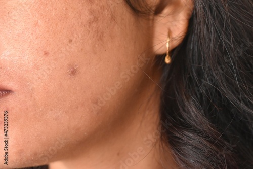 Pimples, Dark spots, freckles, dry skin on face middle age woman, Problem skincare and health concept.