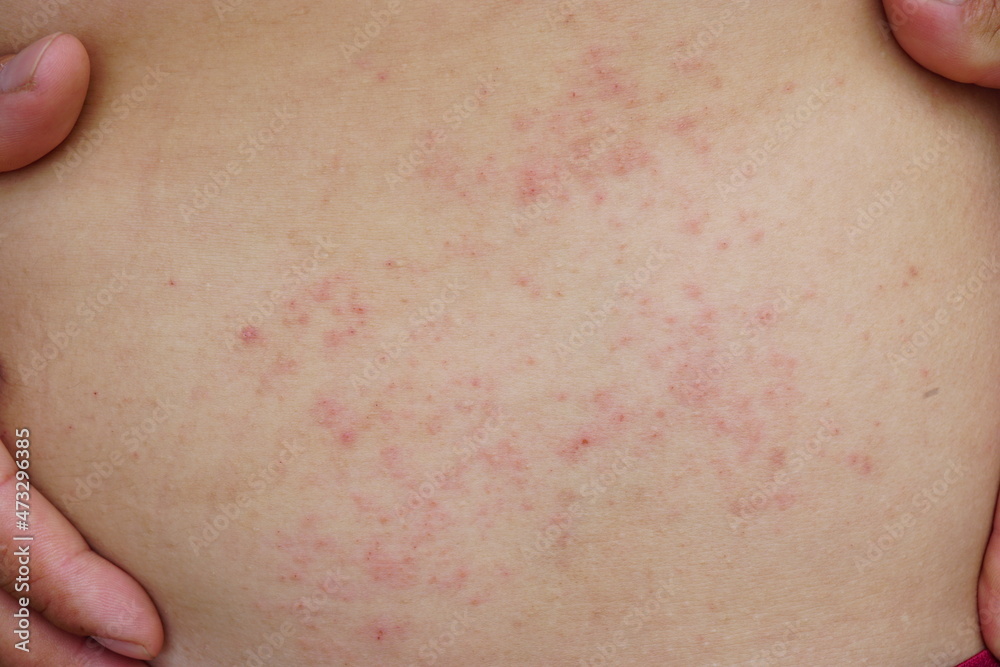 Close up skin rash on body with copy space. Close up skin rash on body with copy space.