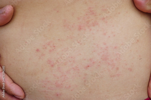 Close up skin rash on body with copy space.