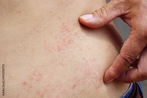 Close up skin rash on body with copy space.