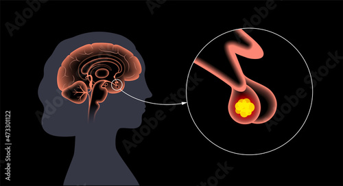 Pituitary adenoma cancer