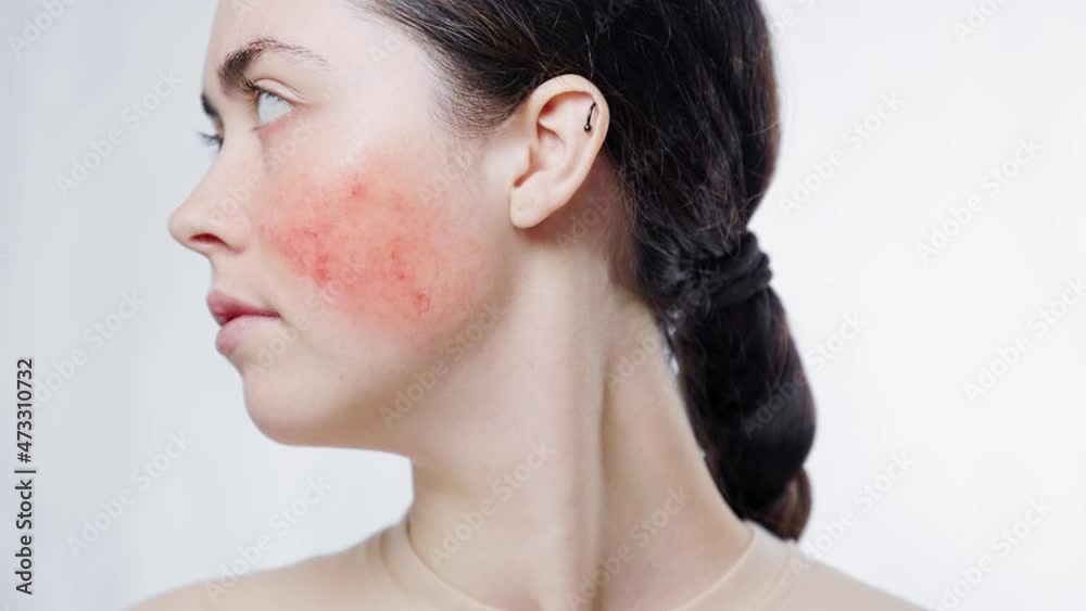 Close-up portrait of a young beautiful woman turning and showing rosacea on her cheek. White background. The concept of aesthetic skin problem