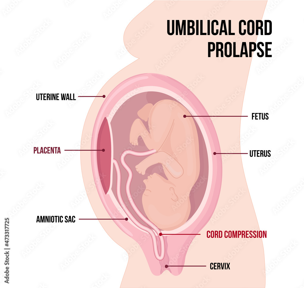 Prolapsed umbilical cord, Medical vector diagram with terms Stock Vector Adobe Stock