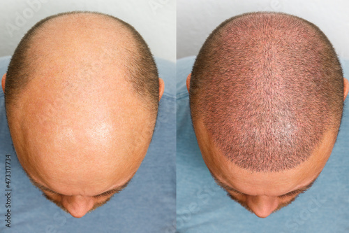 Fotobehang The head of a balding man before and after hair transplant surgery